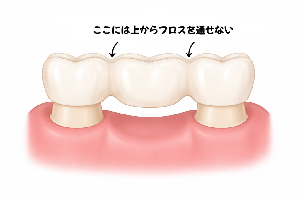 ブリッジの仕組みがわかりやすいイラスト。「ここには上からフロスを通せない」という説明付き。